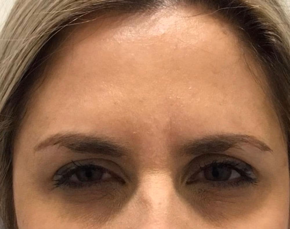 Botox before and after, case 14252 - Cool Springs Plastic Surgery