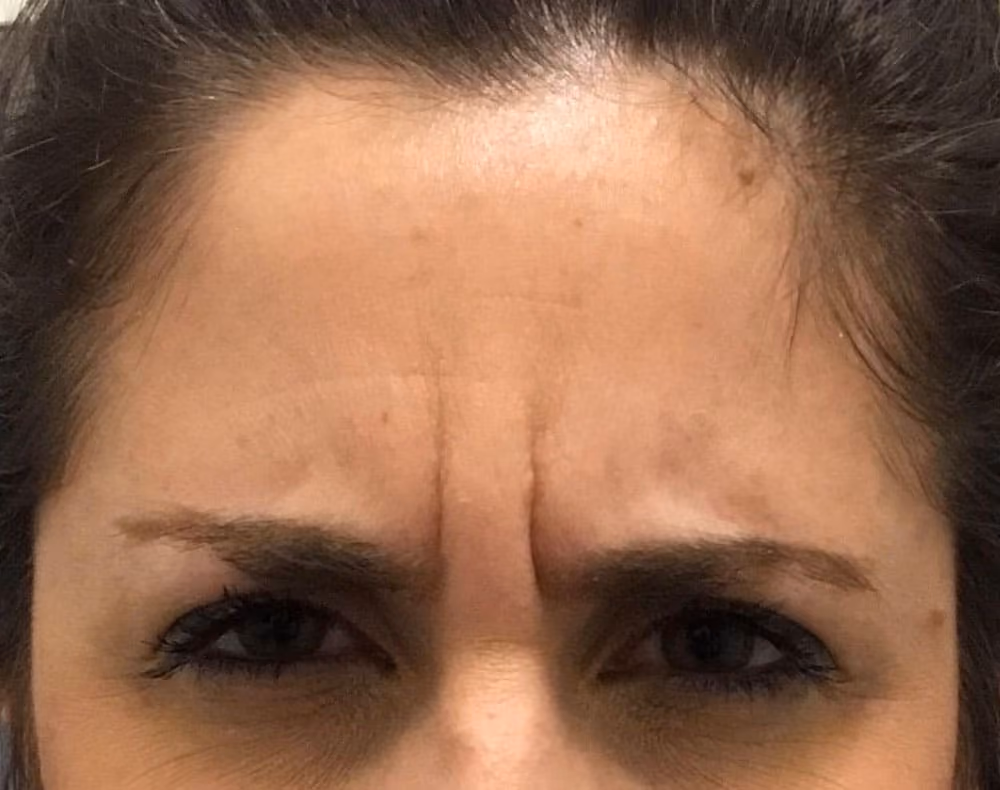 Botox before and after, case 14252 - Cool Springs Plastic Surgery