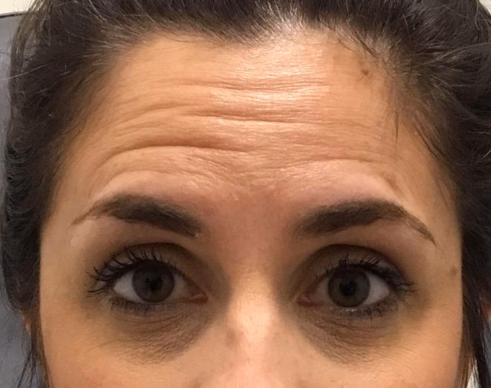 Botox before and after, case 14252 - Cool Springs Plastic Surgery