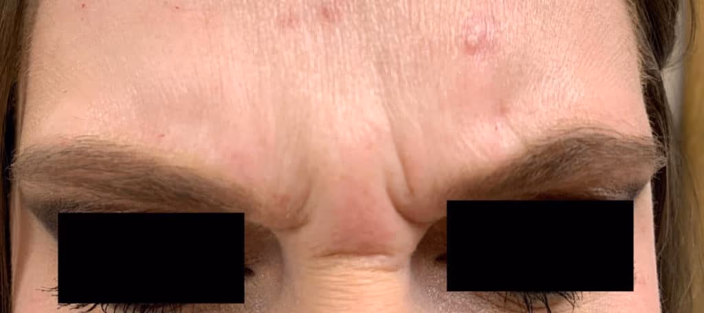 Botox before and after, case 14266 - Cool Springs Plastic Surgery