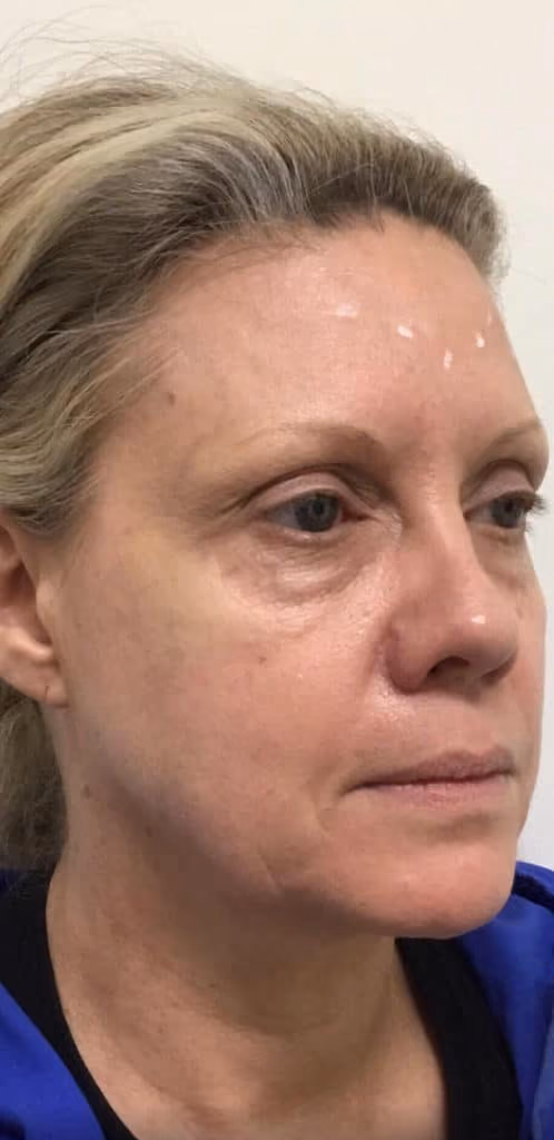 Botox before and after, Michele Bailey, case 15124 - Cool Springs Plastic Surgery