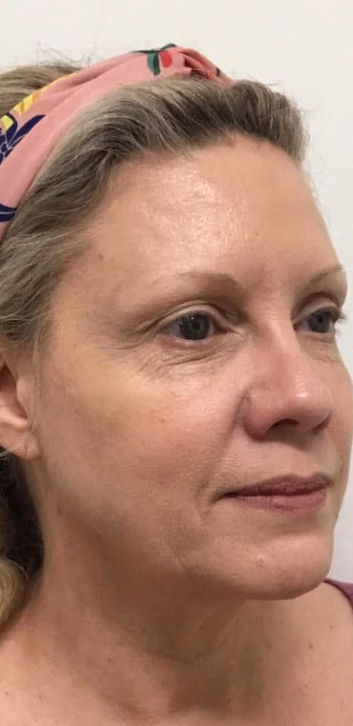 Botox before and after, Michele Bailey, case 15124 - Cool Springs Plastic Surgery