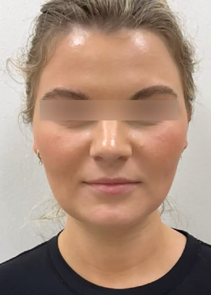 Botox before and after, Laura Sonn, case 15769 - Cool Springs Plastic Surgery