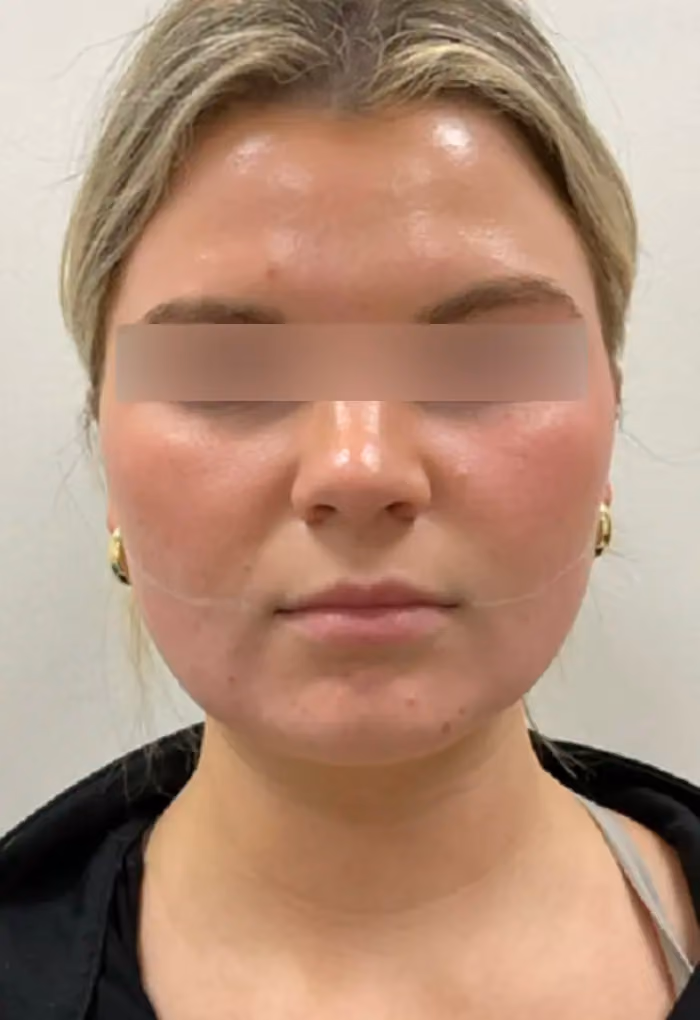 Botox before and after, Laura Sonn, case 15769 - Cool Springs Plastic Surgery