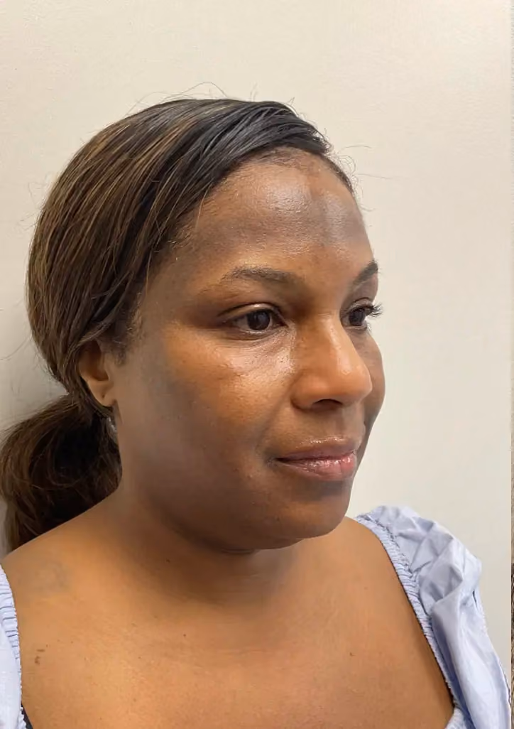 Botox before and after, case 15770 - Cool Springs Plastic Surgery