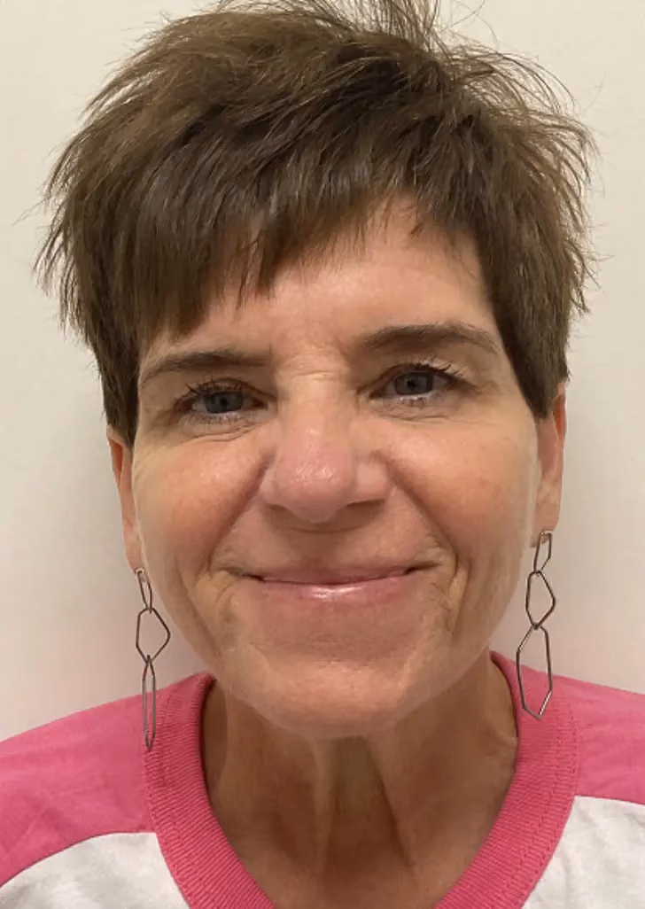 Botox before and after, Olivia Gibson, case 15771 - Cool Springs Plastic Surgery