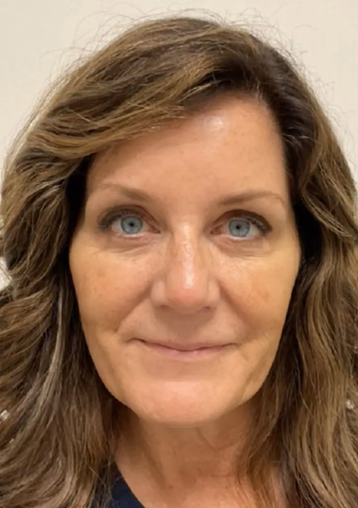 Botox before and after, Olivia Gibson, case 15772 - Cool Springs Plastic Surgery