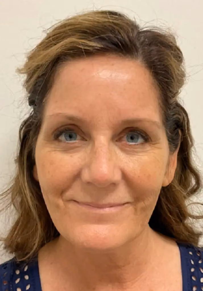Botox before and after, Olivia Gibson, case 15772 - Cool Springs Plastic Surgery