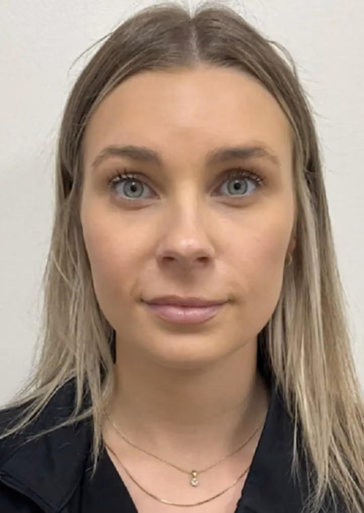 Botox before and after, case 15773 - Cool Springs Plastic Surgery