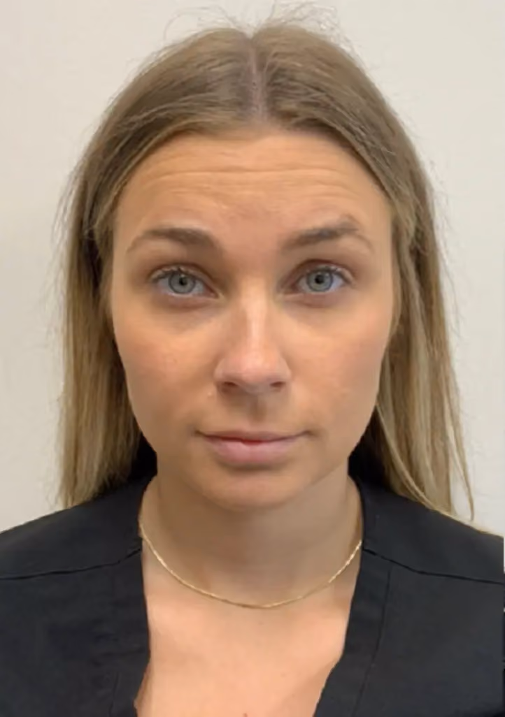 Botox before and after, case 15773 - Cool Springs Plastic Surgery