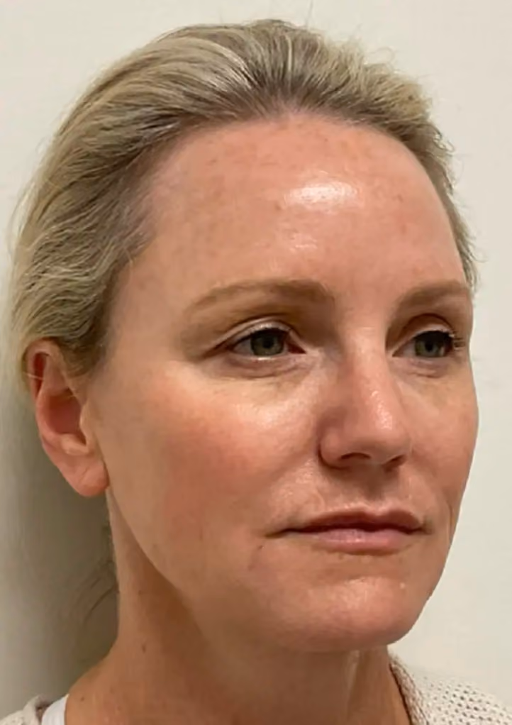 Botox before and after, case 15776 - Cool Springs Plastic Surgery