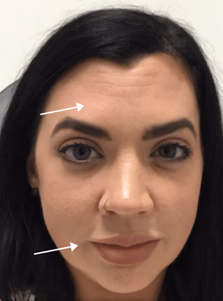 Botox before and after, case 15924 - Cool Springs Plastic Surgery