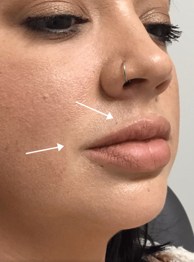 Botox before and after, case 15924 - Cool Springs Plastic Surgery