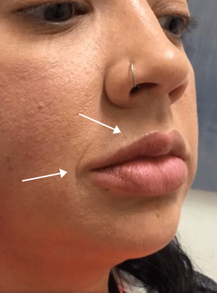 Botox before and after, case 15924 - Cool Springs Plastic Surgery