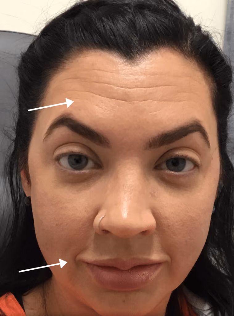 Botox before and after, case 15924 - Cool Springs Plastic Surgery