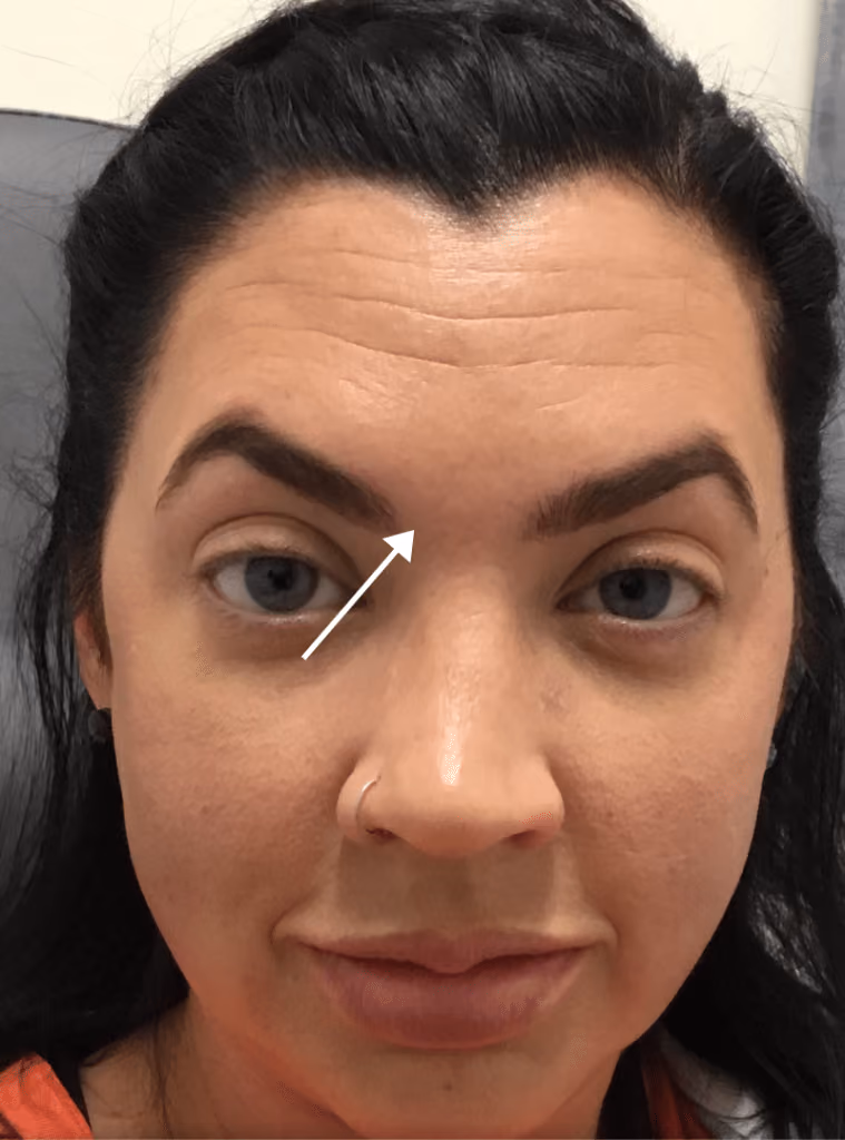 Botox before and after, case 15924 - Cool Springs Plastic Surgery