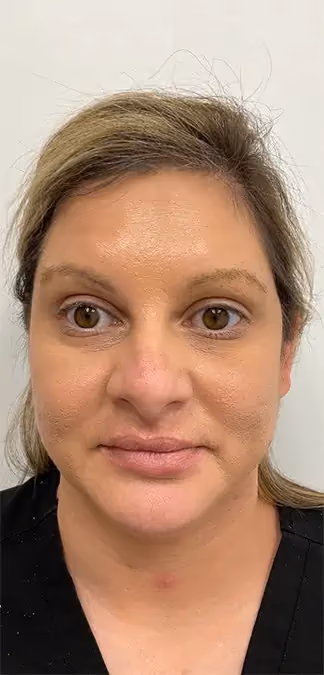 Botox before and after, case 15930 - Cool Springs Plastic Surgery