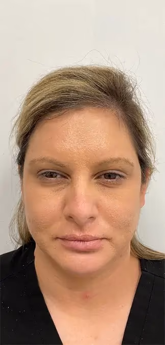 Botox before and after, case 15930 - Cool Springs Plastic Surgery