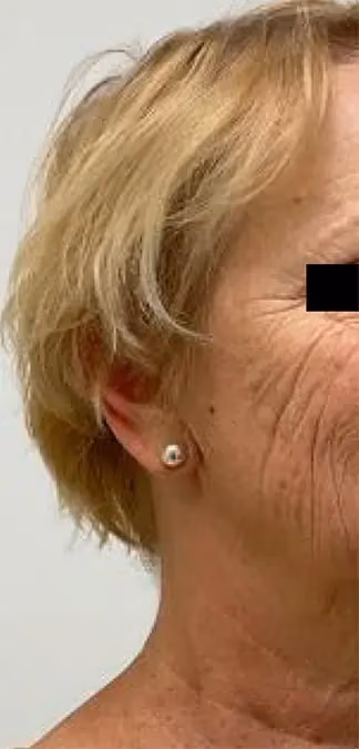 Botox before and after, case 15931 - Cool Springs Plastic Surgery