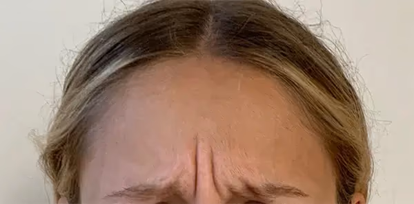 Botox before and after, Teresa Safford, case 15932 - Cool Springs Plastic Surgery