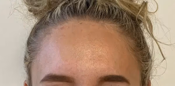 Botox before and after, Teresa Safford, case 15932 - Cool Springs Plastic Surgery