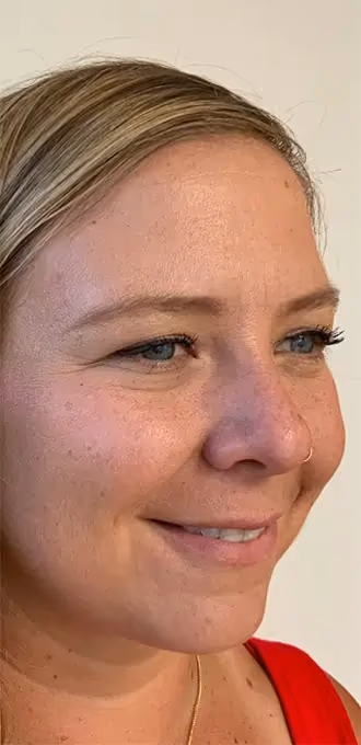 Botox before and after, Teresa Safford, case 15934 - Cool Springs Plastic Surgery