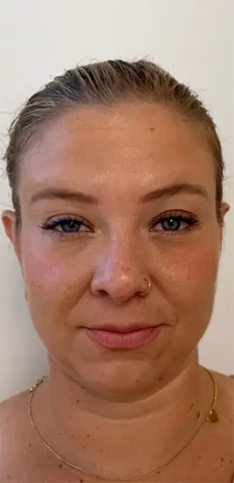 Botox before and after, Teresa Safford, case 15934 - Cool Springs Plastic Surgery