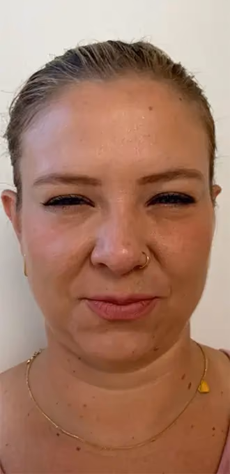 Botox before and after, Teresa Safford, case 15934 - Cool Springs Plastic Surgery