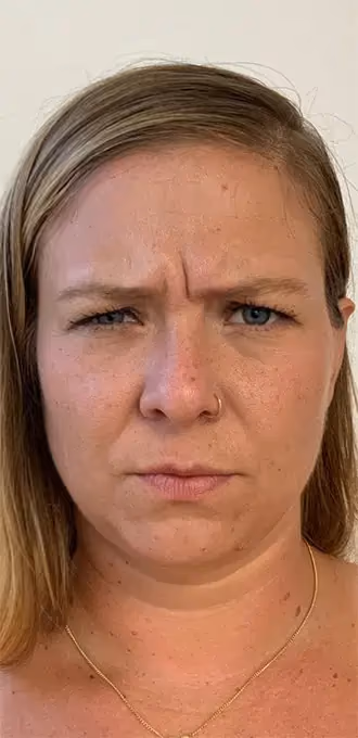 Botox before and after, Teresa Safford, case 15934 - Cool Springs Plastic Surgery