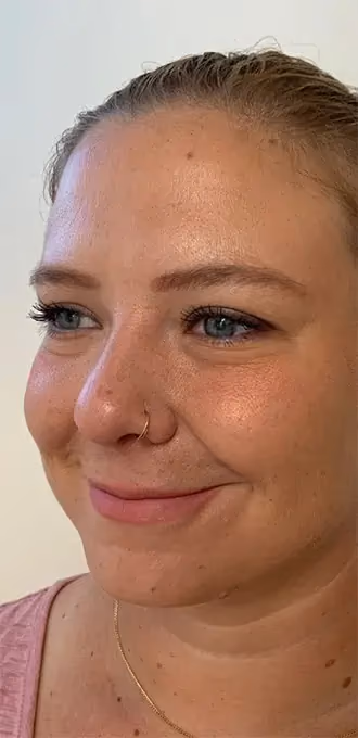Botox before and after, Teresa Safford, case 15934 - Cool Springs Plastic Surgery