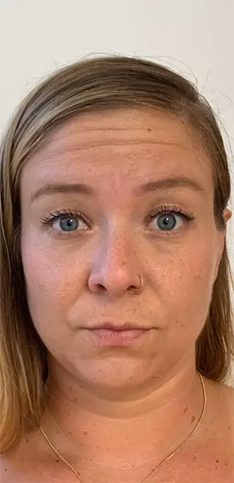 Botox before and after, Teresa Safford, case 15934 - Cool Springs Plastic Surgery