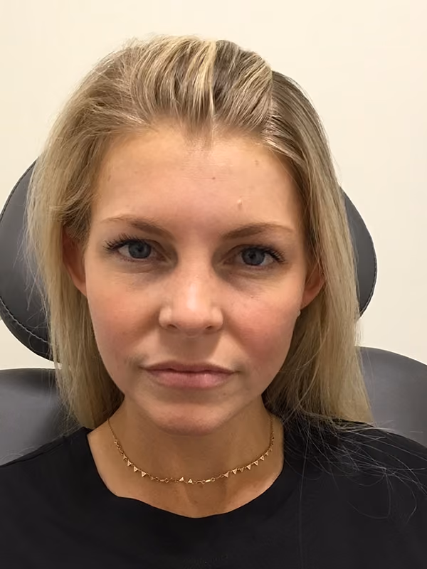 Botox before and after, case 16206 - Cool Springs Plastic Surgery