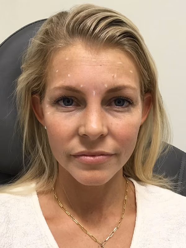 Botox before and after, case 16206 - Cool Springs Plastic Surgery