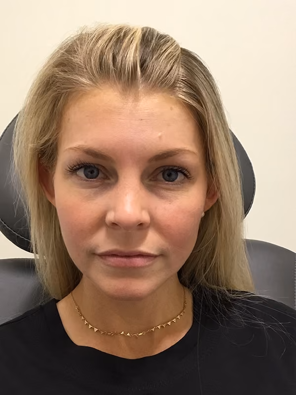 Botox before and after, case 16206 - Cool Springs Plastic Surgery