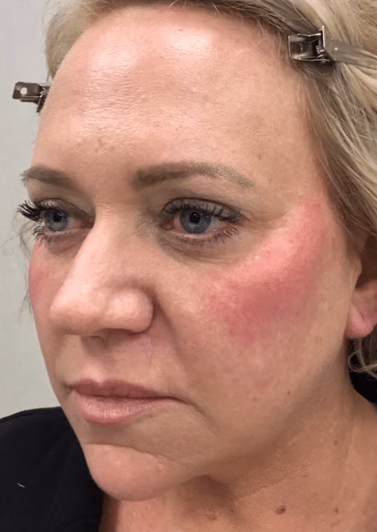 Botox before and after, Olivia Salmen, case 17163 - Cool Springs Plastic Surgery
