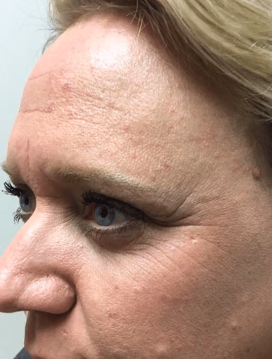 Botox before and after, Olivia Salmen, case 17163 - Cool Springs Plastic Surgery