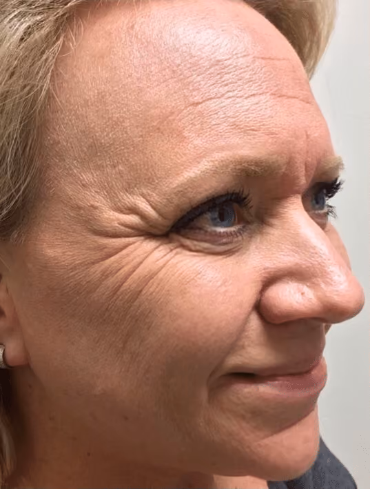Botox before and after, Olivia Salmen, case 17163 - Cool Springs Plastic Surgery
