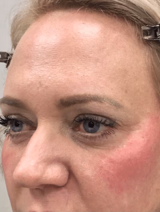 Botox before and after, Olivia Salmen, case 17163 - Cool Springs Plastic Surgery