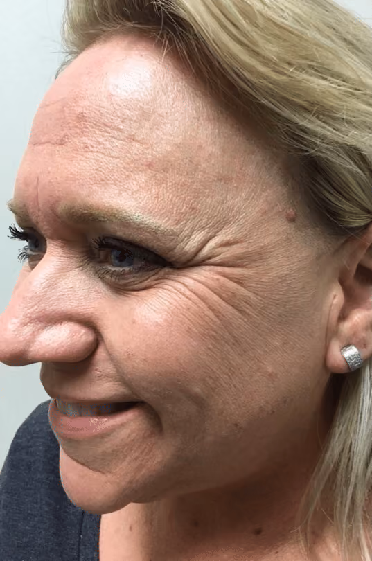 Botox before and after, Olivia Salmen, case 17163 - Cool Springs Plastic Surgery