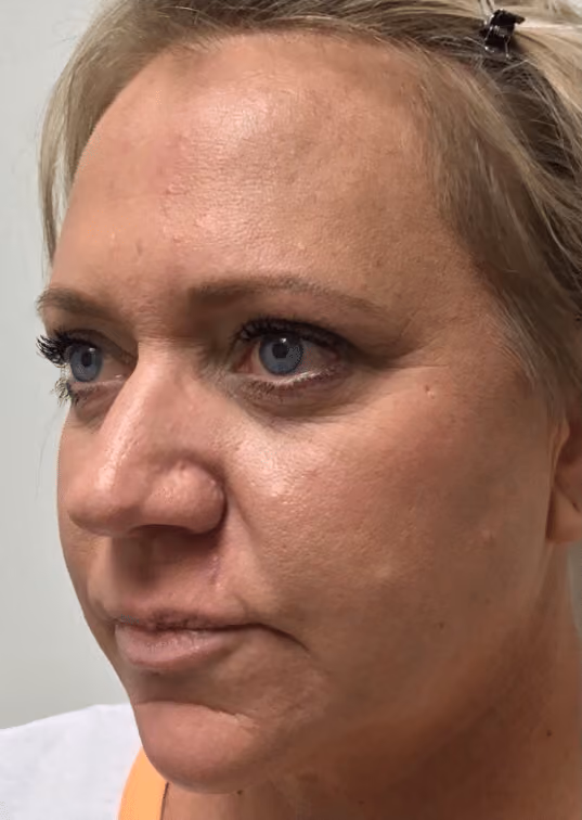 Botox before and after, Olivia Salmen, case 17163 - Cool Springs Plastic Surgery