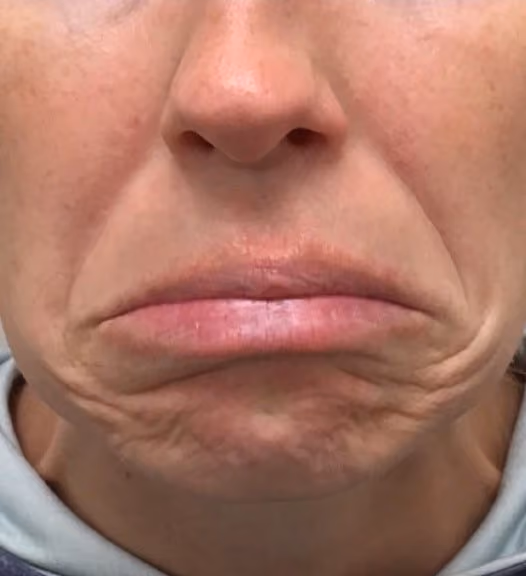 Botox before and after, Olivia Salmen, case 17270 - Cool Springs Plastic Surgery