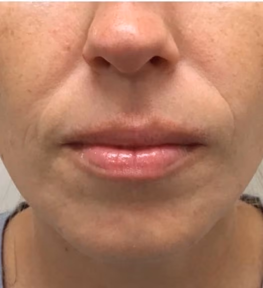Botox before and after, Olivia Salmen, case 17270 - Cool Springs Plastic Surgery