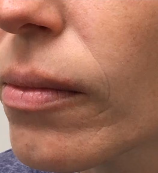 Botox before and after, Olivia Salmen, case 17270 - Cool Springs Plastic Surgery