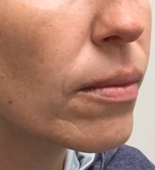 Botox before and after, Olivia Salmen, case 17270 - Cool Springs Plastic Surgery