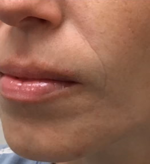 Botox before and after, Olivia Salmen, case 17270 - Cool Springs Plastic Surgery