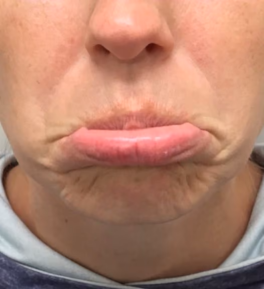 Botox before and after, Olivia Salmen, case 17270 - Cool Springs Plastic Surgery