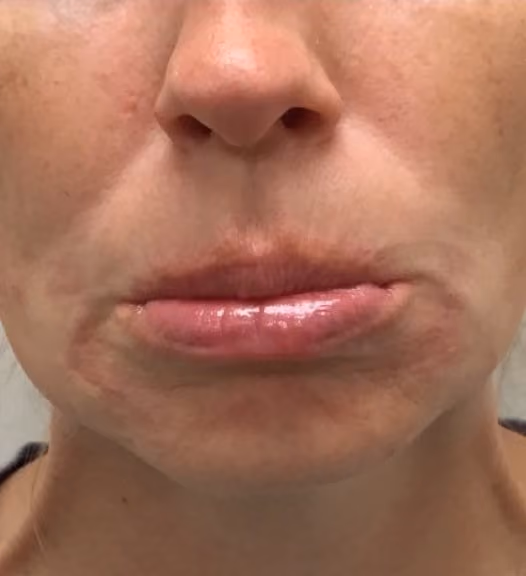 Botox before and after, Olivia Salmen, case 17270 - Cool Springs Plastic Surgery