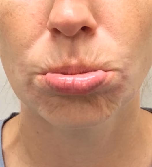 Botox before and after, Olivia Salmen, case 17270 - Cool Springs Plastic Surgery