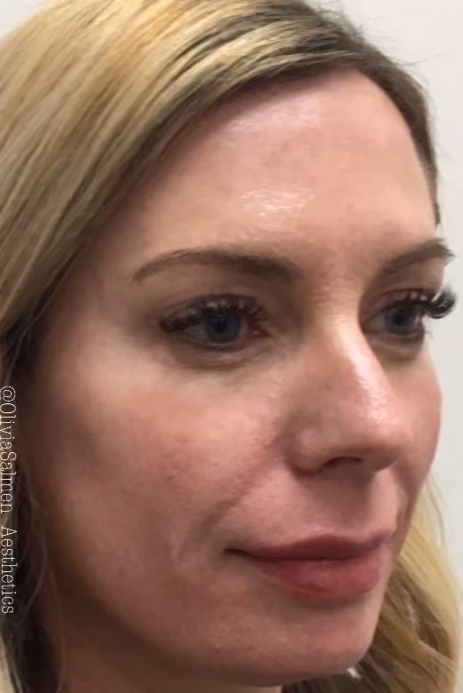 Botox before and after, Olivia Salmen, case 17341 - Cool Springs Plastic Surgery