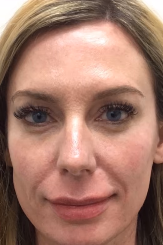 Botox before and after, Olivia Salmen, case 17341 - Cool Springs Plastic Surgery